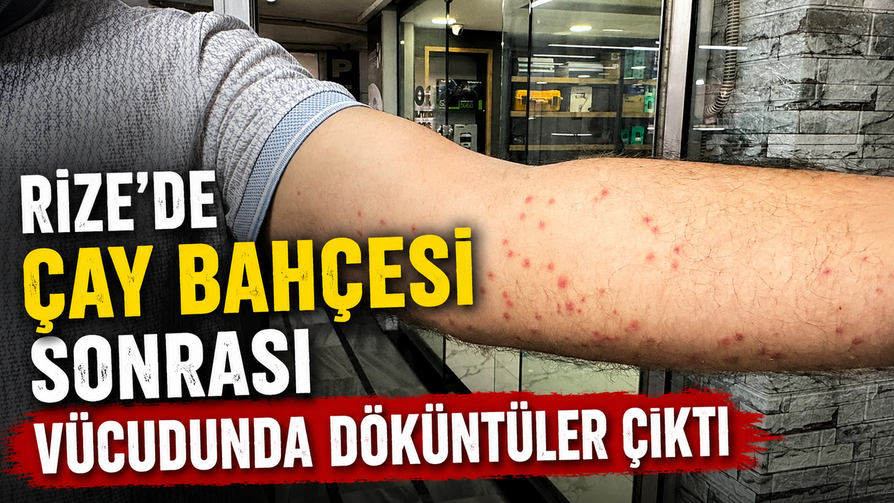 Rize’de Çay Bahçesi Sonrası Vücudunda Döküntüler Çıktı