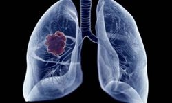 Akciğer Kanseri Dünyada Giderek Artıyor