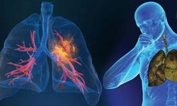 DDBT, Akciğer Kanseri Ölümlerini Yüzde 20 Azaltıyor