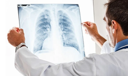 Uzmanı Uyardı: "Akciğer Kanserinde Beslenme Bağışıklığı Etkiliyor