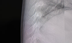 Bebeğin Sırtından Tel Parçası Çıktı