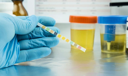 İdrar Rengi, O Hastalığın Habercisi Olabilir