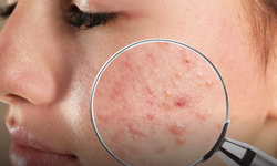 Özellikle Akne Tedavilerinde Bunu Yapmayın!
