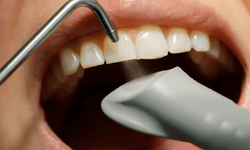 Sosyal Medyada Yaygınlaşan Diş Ürünleri Tehlike Saçıyor