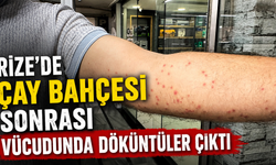 Rize’de Çay Bahçesi Sonrası Vücudunda Döküntüler Çıktı