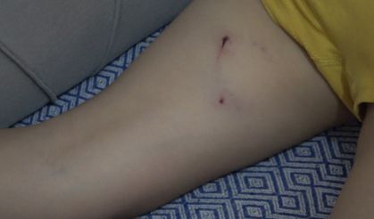 Rize’de 5 yaşındaki çocuk, sokak köpeğinin saldırısına uğradı