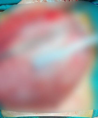 Kilo Vermek İçin Hastaneye Giden Çocuğun Karnından 3,5 Kiloluk Kist Çıktı