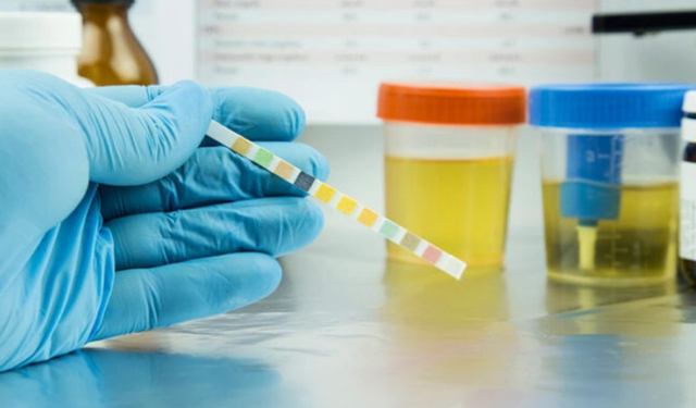 İdrar Rengi, O Hastalığın Habercisi Olabilir