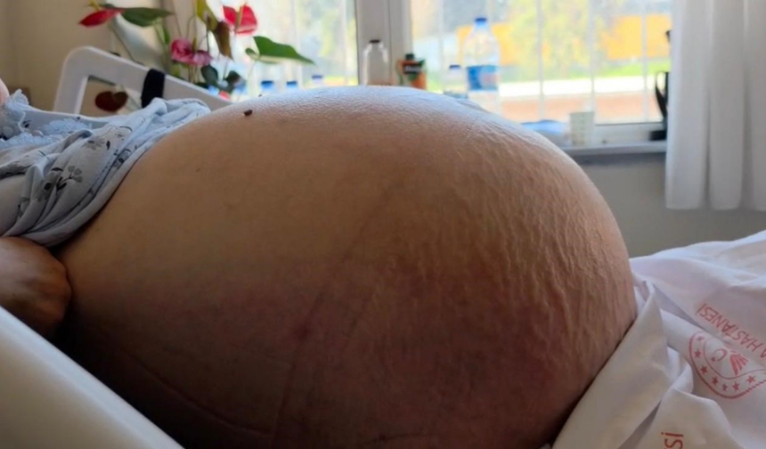 Doktorları Şaşkına Çeviren Olay! Hepsi Karnından Çıktı