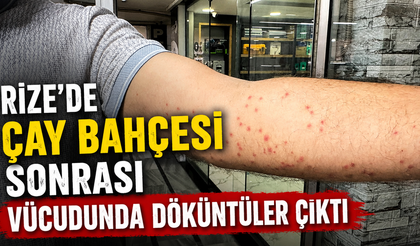 Rize’de Çay Bahçesi Sonrası Vücudunda Döküntüler Çıktı